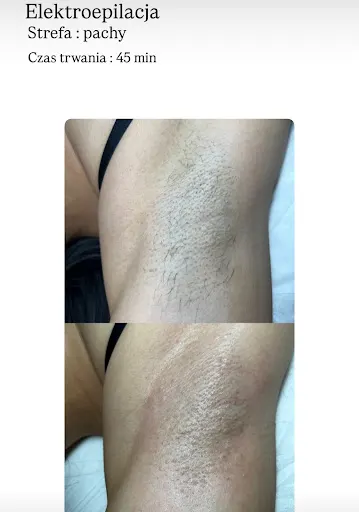 Depilacja Elektroepilacja Pruszków - IMPULS.STUDIO